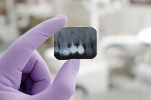 Dental Fillings