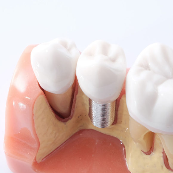 Tooth Replacement (Implants, Bridges, Dentures)